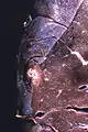 Un abcès sous-pleural.