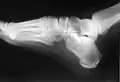 Radio d'une fracture du calcanéus.