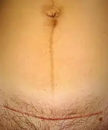 Cicatrice d'une césarienne (ligne horizontale rouge) et Linea nigra chez une femme de trente-et-un ans, sept semaines après l’accouchement.