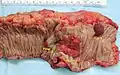Apparence d'une colectomie révélant deux polypes adénomateux (tumeurs ovales brunâtres) et un carcinome colorectal invasif (cratère rougeâtre).