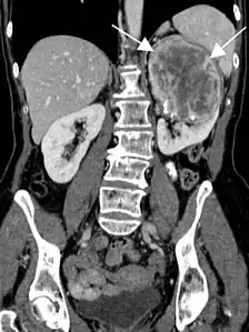 TDM abdominal en coupe frontale.