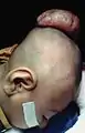 Encephalocèle sur la tête d'un enfant de deux ans.