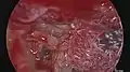 Visualisation endoscopique d'une platinotomie