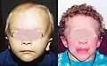 Contour du visage, vu de face, de forme triangulaire, avec des tempes larges se rétrécissant en un menton étroit.