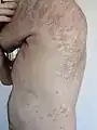 Psoriasis en gouttes sur un homme de 66 ans.