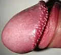 Un gland avec des papules perlées (vue globale).