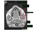 IRM de tête au niveau des dents mandibulaires, avec le muscle masséter.