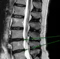 IRM lombaire sagittale montrant des protrusions discales.