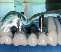Bridge sur implants