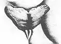 Hypertrophie labiale