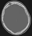 Par comparaison, scanner de métastases ostéolytiques dans l'os du crâne d'une patiente souffrant d'un cancer du sein. On distingue une ostéolyse plus grande sur le front, et plusieurs plus petites.