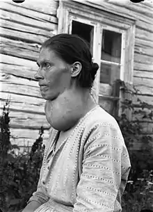 Photographie d'une femme ayant un goitre, symptôme d'une carence en iode.