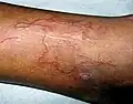 Lésions serpentiformes typiques d'une larva migrans cutanée, sur une jambe