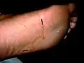 Larva migrans sur une plante de pied