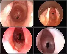 4 vues de fibroscopie montrant l'intérieur de la trachée, aux couleurs dominantes rose et rouge sur fond noir.