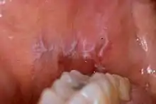 Lichen plan buccal.