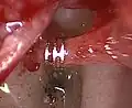 Mise en place de la prothèse accrochée sur la branche descendante de l'enclume gauche (vue microscopique)