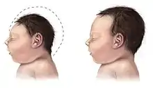 dessin montrant le profil de la tête de 2 nouveau-nés l'un ayant un petit crâne microcéphale et l'autre normal
