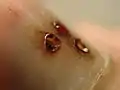 Ongle du pouce de pied à la suite du perçage
