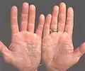 Psoriasis en plaque sur la paume des mains
