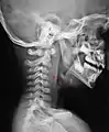Un abcès rétropharyngien