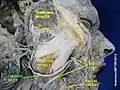 Dissection anatomique représentant le conduit parotidien par rapport au muscle masséter, et à la veine faciale
