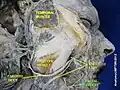 Dissection de la face montrant l'artère faciale. Vue de profil.