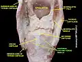 Muscle cricoaryténoïde postérieur