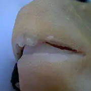 Dents.