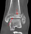 Une fracture triplane de la cheville vue par TDM
