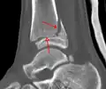 Une fracture triplane de la cheville vue par TDM