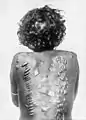 Scarifications sur le dos d'une femme Larrakia