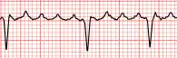 Image illustrative de l’article Flutter atrial